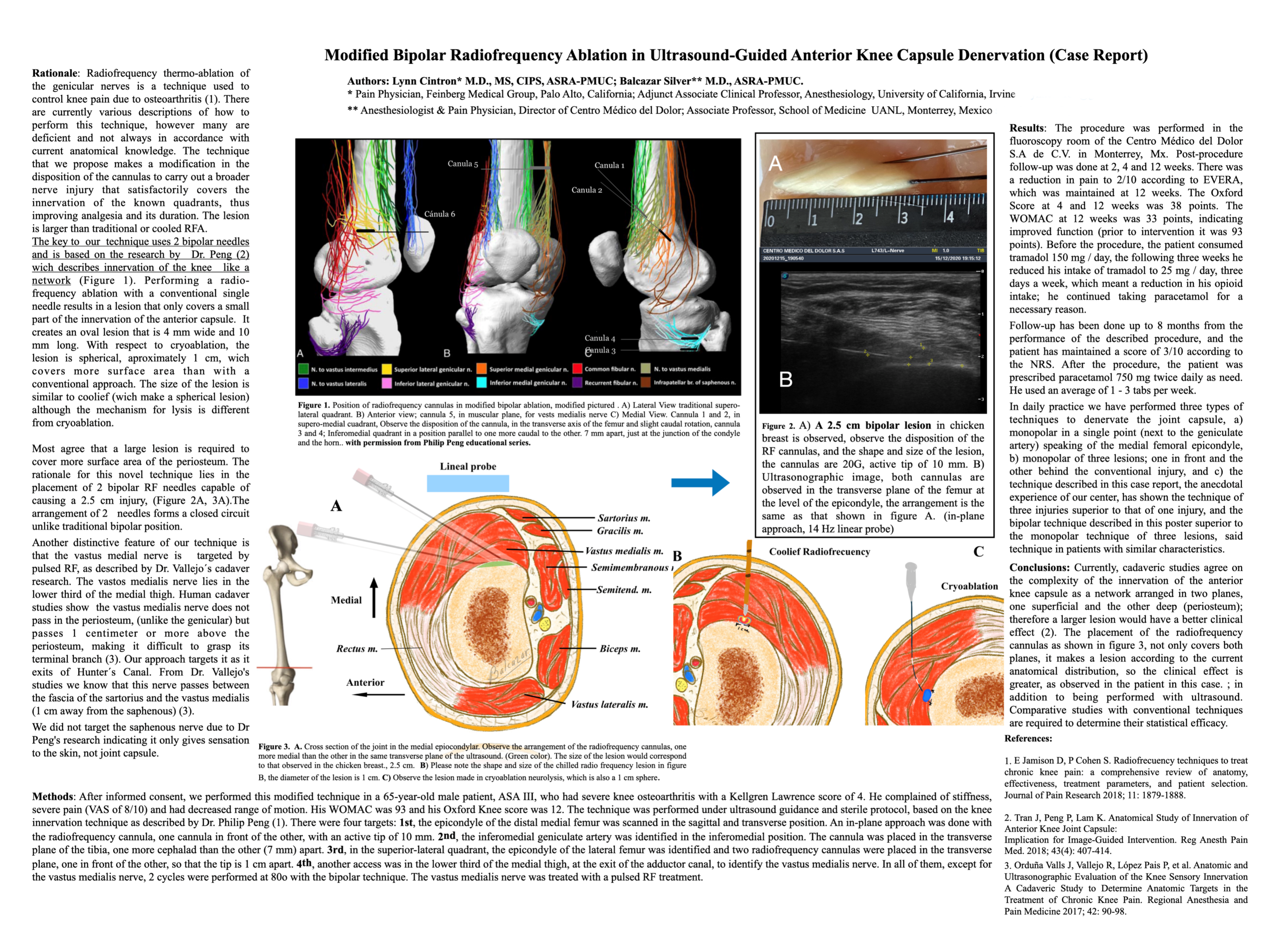 Modified Bipolar Radiofrequency Ablation in Ultrasound Guided Anterior ...