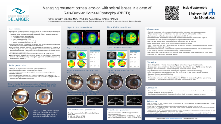 Managing recurrent corneal erosion with scleral lenses in a Reis ...